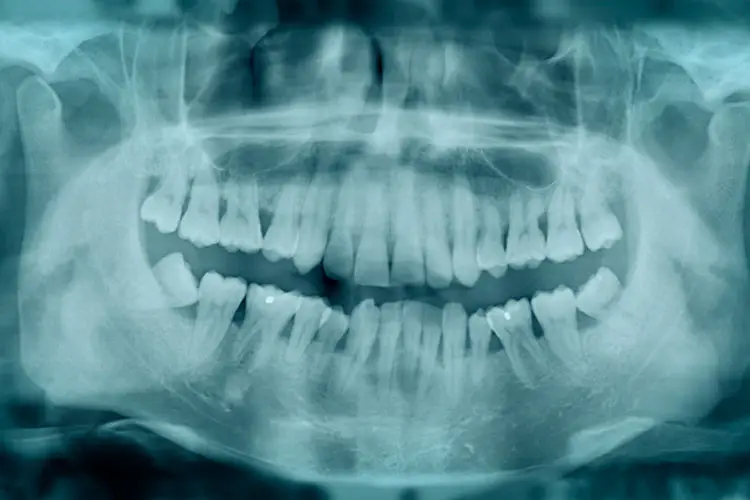 Treatment for Adult Underbite Correction