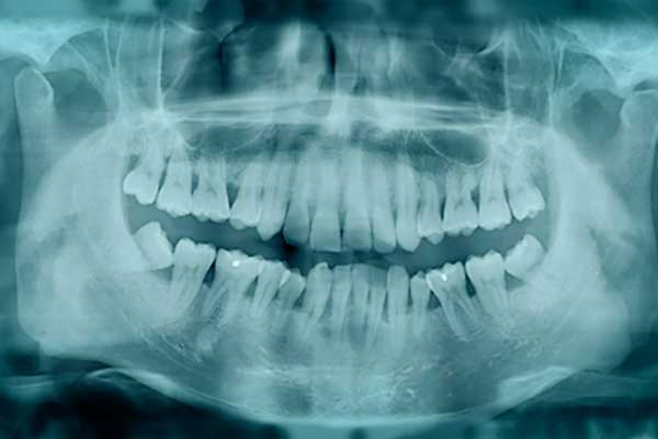 Overcrowded Teeth, Crooked, Twisted Teeth and Bite Correction