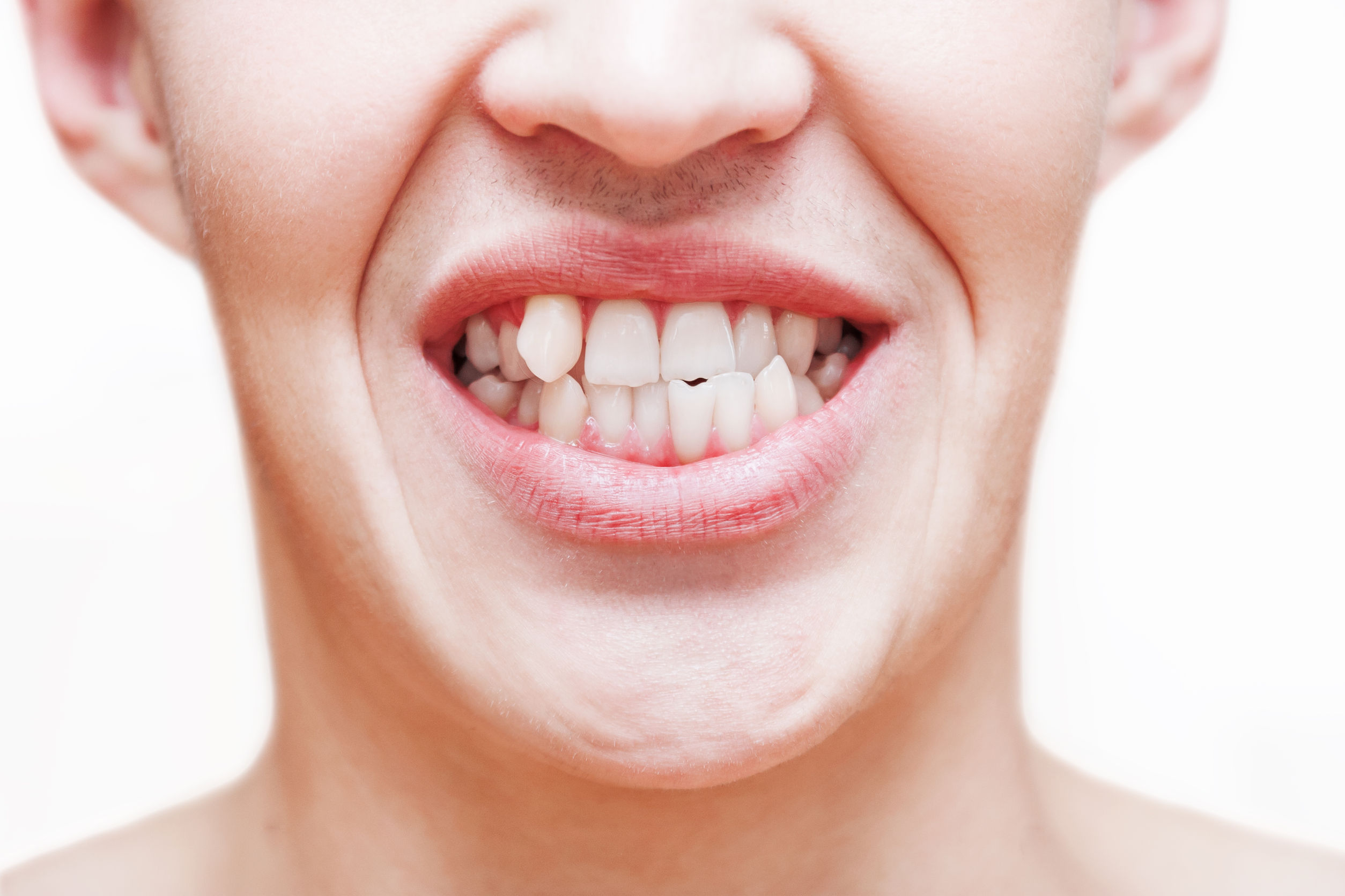 Crooked Teeth: Embarrassing, Unsightly and Possibly Deadly