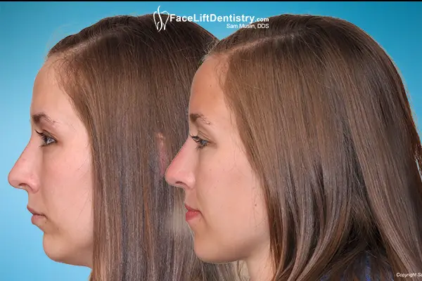 Small Chin and Overbite Fixed by Nonsurgical Facelift