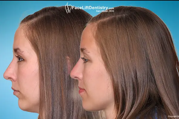 Small Chin And Overbite Fixed By Nonsurgical Facelift Bite Correction