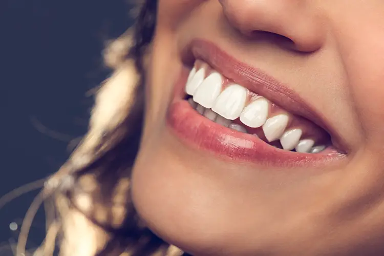 What You Need to Know About Veneers