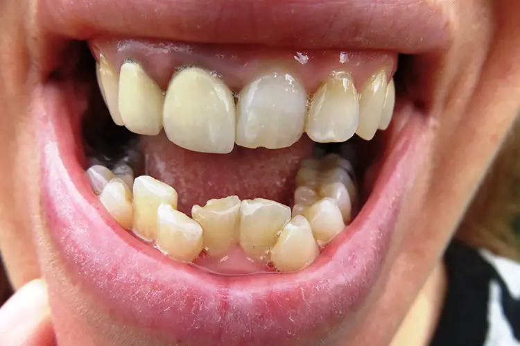 Crossbite Correction: The Effects and Treatment Options