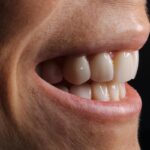 Celebrity Veneers Exposed