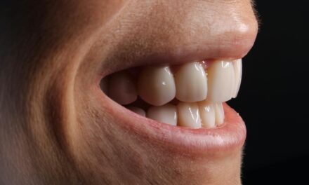 Celebrity Veneers Exposed