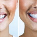 Top Invisalign Dentists Edmonton