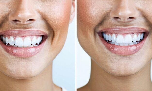 Top Invisalign Dentists Edmonton