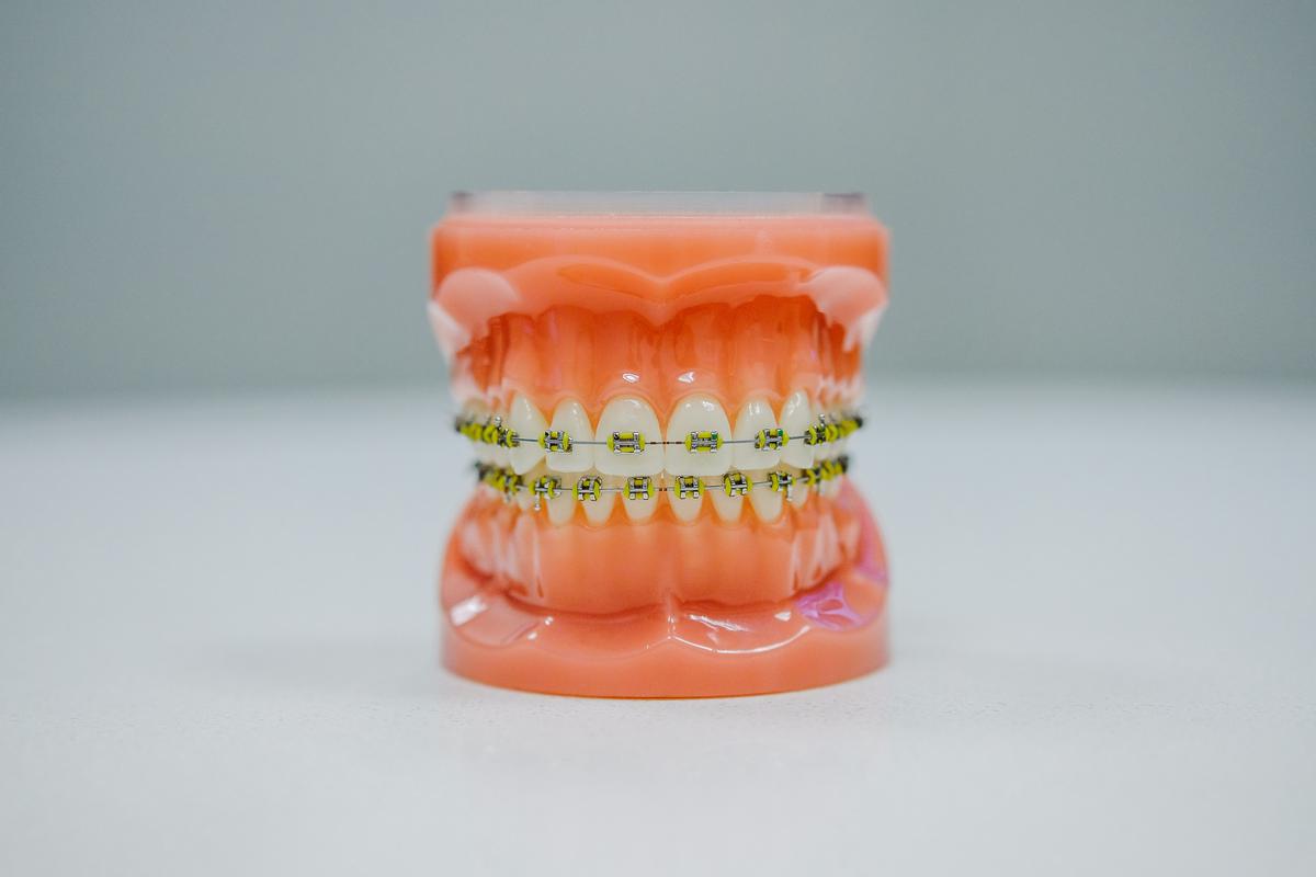 A visual representation of the various treatment options for underbites, including braces, clear aligners, palatal expanders, and orthognathic surgery, depending on the severity and type of underbite.