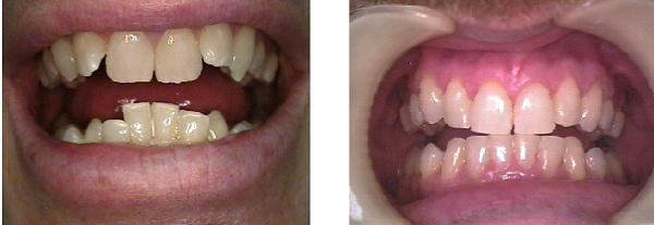 A side-by-side comparison of traditional braces and the JawTrac device, illustrating the differences in approach and invasiveness between the two jaw alignment methods